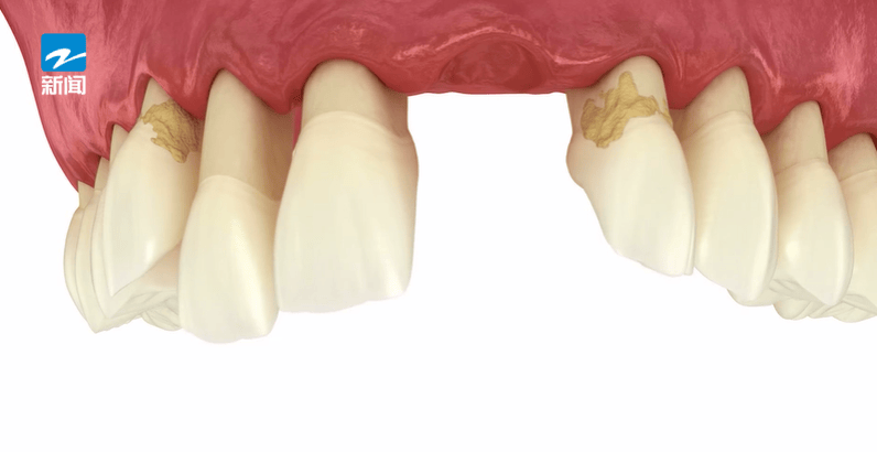 皇冠信用盘登123出租_44岁女子牙齿掉光皇冠信用盘登123出租！只因这个很多人都忽视的“小问题”……